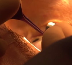 Процесс имплантации ювелирного изделия в глаз