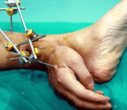 Ради спасения отрезанной руки, врачи пришили ее к ноге пациента. Фото healthnewsline.net